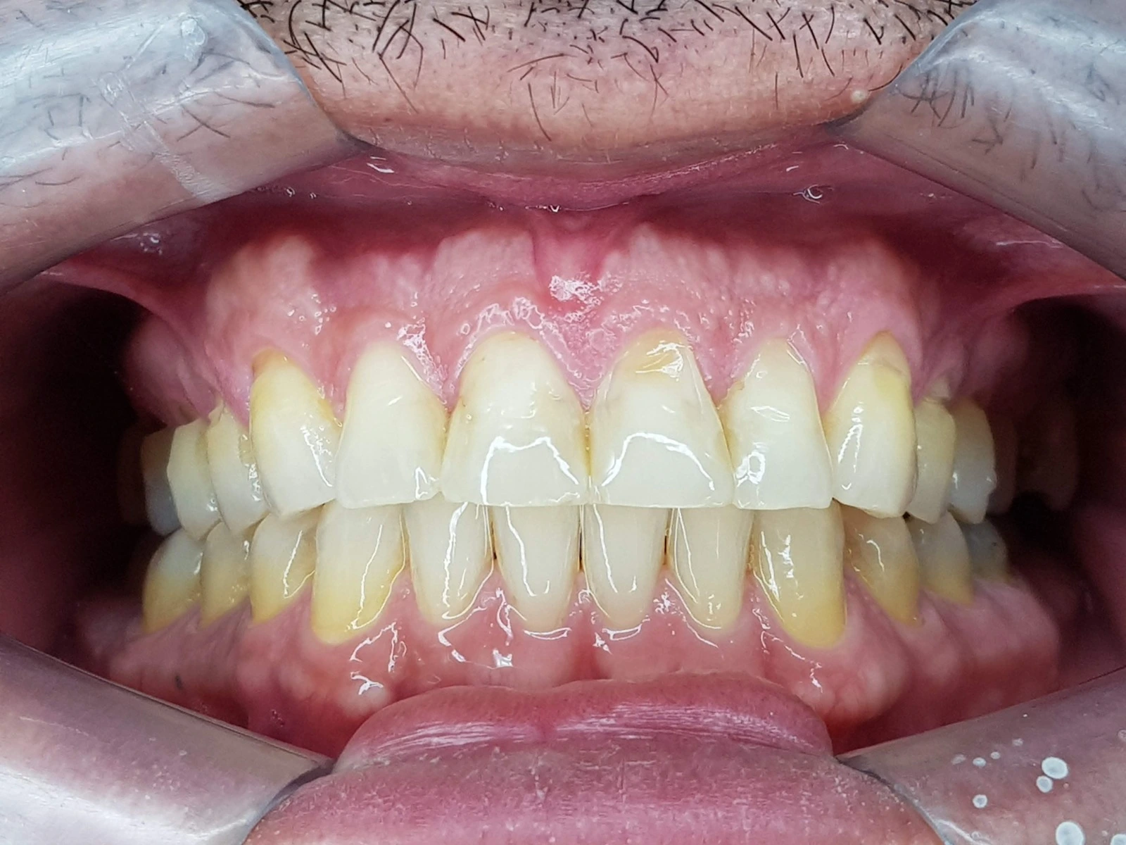 Tratamento de retração gengival no Tatuapé — Sannre Odontologia
