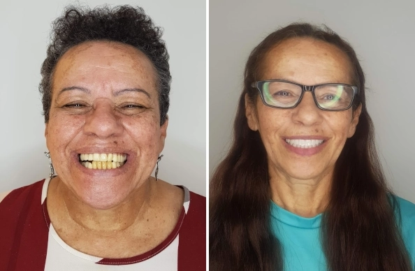 Implantes dentários no Tatuapé